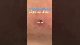 Massive blackhead extraction 