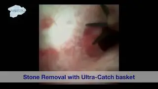 Stone Removal with Ultra-Catch Basket