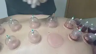 Hidžama, ili terapija mokrim čašicama
