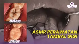 ASMR Perawatan Tambal Gigi | Dental Tooth Filling ASMR