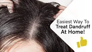 How To Remove Dandruff At Home | Home Remedies