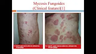 Primary  Cutaneous Lymphomas