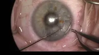 Arcuate Dehiscence
