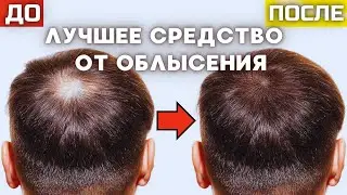 ГАЙД ПРО МИНОКСИДИЛ | РЕЗУЛЬТАТ, ПЕРЕРЫВЫ,  ПОБОЧКИ | МИНОКСИДИЛ ОТ ОБЛЫСЕНИЯ | МИНОКСИДИЛ ДЛЯ ВОЛОС