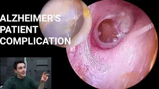 Alzheimer's Confusion Worsened By Double Ear Infection (Effusion & CSOM)