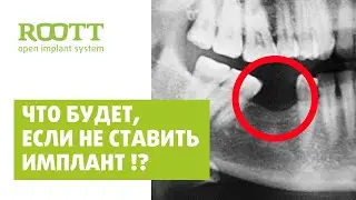 Атрофия костной ткани челюсти. Атрофия кости после удаления зуба. Стоматология ROOTT