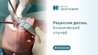 👉 Рецессия десны. Клинический случай