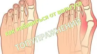 Как избавиться от вальгуса/Топ упражнений от вальгуса