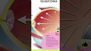 Common eye conditions - Glaucoma  #eyedisease #facts