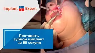Поставить зубной имплант за 60 секунд