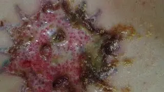 Tattoo Infections