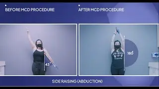 Pain Alleviated and Mobility Restored! Frozen Shoulder Treatment in One Visit!