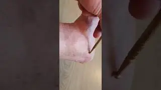 Самолечение иглами. Боль в пятке.
