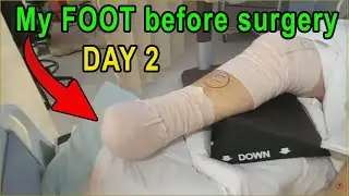 3.  update on surgery as they delay after my Motorcycle crash