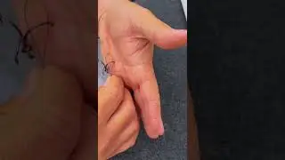 How To Remove A Hook (Deep In The Hand) 