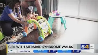 Indy girl born with fused legs takes first steps