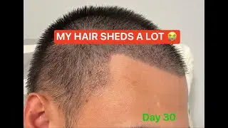 OMG, HAIR  ALREADY SHEDDING!! From San Francisco to Motion Hair Clinic, Korea - 4 weeks post op