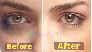 Home Remedies To Get Rid Of Dark Circles & Puffy Eyes | Remove Dark Circles | Wrinkles |  Dryness |