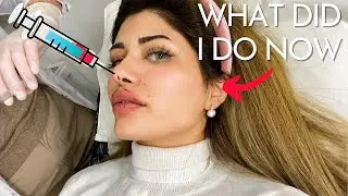 Face Fillers ❗️Russian Lips Before & After in Detail ((Painful & Graphic))