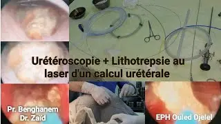 urétéroscopie + Lithotrepsie au laser d'un calcul urétérale