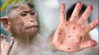 Que Pasaria si la VIRUELA Del MONO se Expande por Todo El MUNDO