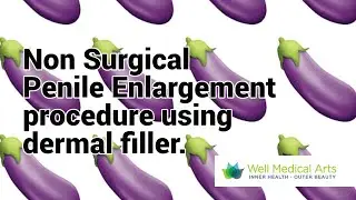 Penis Enlargement using dermal filler - Typical 1st Treatment with before and after