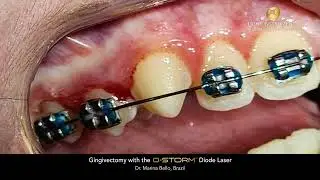 Gingivectomy with the D-Storm™ Diode Laser