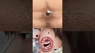 ASMR Dirt and stone removal in deep belly button|  Cleaning big hole swollen face piercings