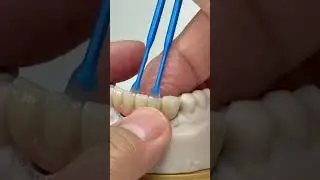 5 unit from 2 implants!