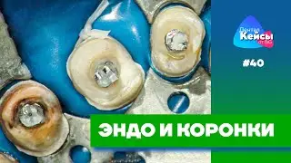 Эндо и коронки | Дентал Кейсы от BG #40