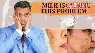 Milk Is Causing Pigmentation, Acne,Indigestion And Constipation  - Dr. Vivek Joshi