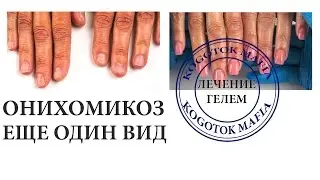 ОНИХОМИКОЗ КЛИНИЧЕСКИЙ. КАК ВЫЛЕЧИТЬ? Автор Елена Дзык