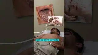 First Time Acupuncture and Cupping on Reality TV Star
