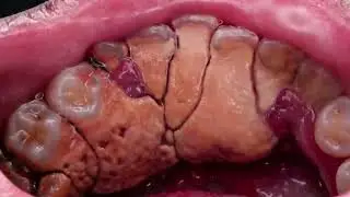 GIGANTIC HUGE TARTAR - UNBELIEVABLY REMOVE