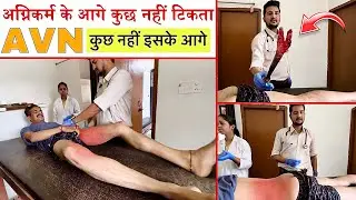 AVN में अग्निकर्म करोगे तो ये होगा🔥 | Agnikarma in AVN Disease | Dr.Amit Bharti Sir