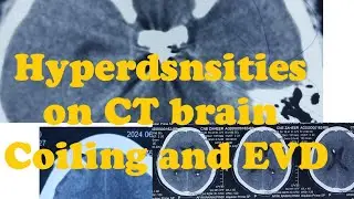 Understand CT brian , Hyperdense on ct brain Coil & EVD tube