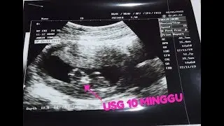 Di USG 10 Minggu