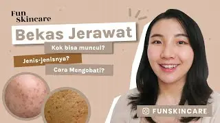 Skincare untuk Bekas Jerawat - PIH, PIE, Bopeng #skintalk