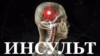 Инсульт. Лечение в Китае. Первый клинический госпиталь Тяньцзинь. Академик Ши Суэмин 18+
