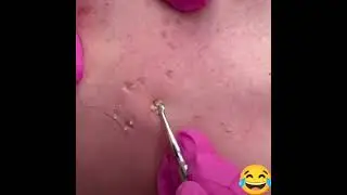 Самое залипательное видео давить прыщи Черные точки