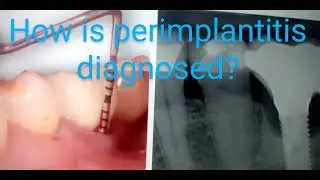 How is Peri-implantitis diagnosed ?#perimplantitis#implant#dentist #diagnosis