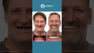 Dental Implant Before and After Transformations