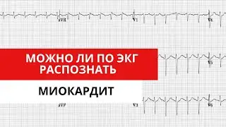 ЭКГ при МИОКАРДИТЕ. Как отличить от инфаркта.