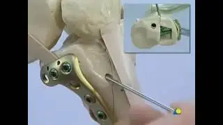 Tibial Plateau --Bicondylar Fracture