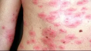 Plague of toxic oak moths which cause horrific skin scabs, severe vomiting, and soaring fevers hits