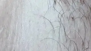Massive Ingrown | Extraction