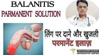 Best treatment of balanitis । लिँग पर लाल दाने ओर खुजली का परमानेंट इलाज़ । Balanitis treatment ।