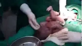 عملية ولادة اون لاين (فيديو صعب)