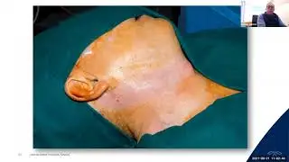 Surgical Management of Head and Neck Neoplasms. Part 3