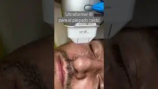 ¿Vale la pena Ultraformer III para párpados caídos?